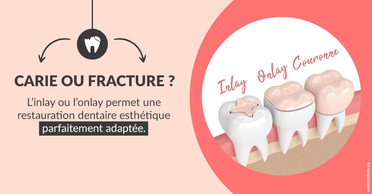 https://dr-patrick-missika.chirurgiens-dentistes.fr/T2 2023 - Carie ou fracture 2