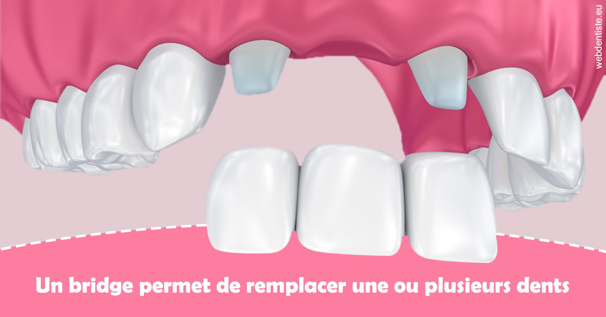 https://dr-patrick-missika.chirurgiens-dentistes.fr/Bridge remplacer dents 2