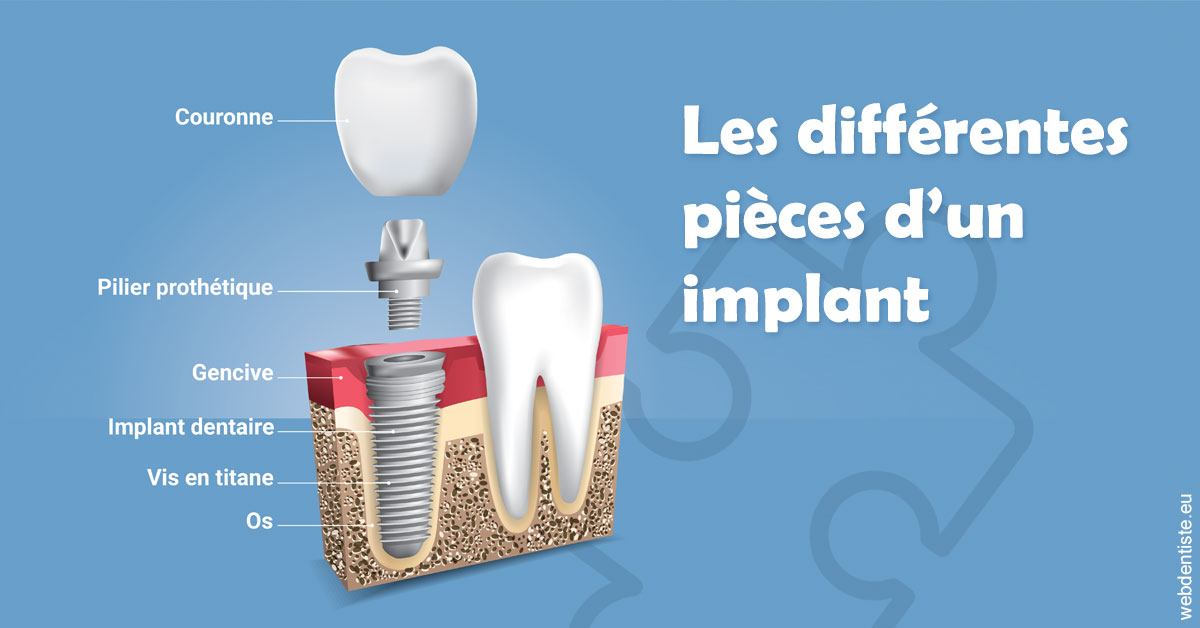 https://dr-patrick-missika.chirurgiens-dentistes.fr/Les différentes pièces d’un implant 1